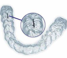 Cosmetic Dentistry: Understanding the Benefits of Invisalign 