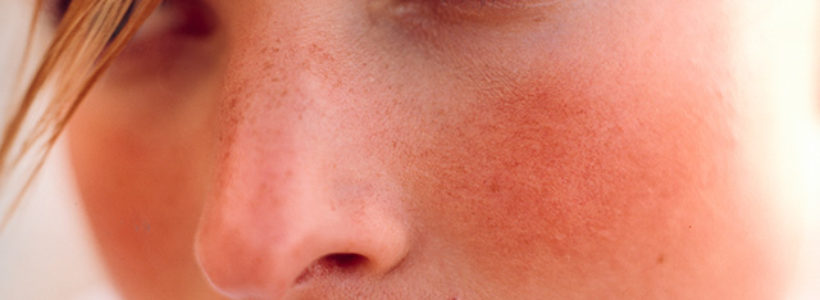 Do This To Your Rosacea Prone Skin And It Will Be Grateful To You