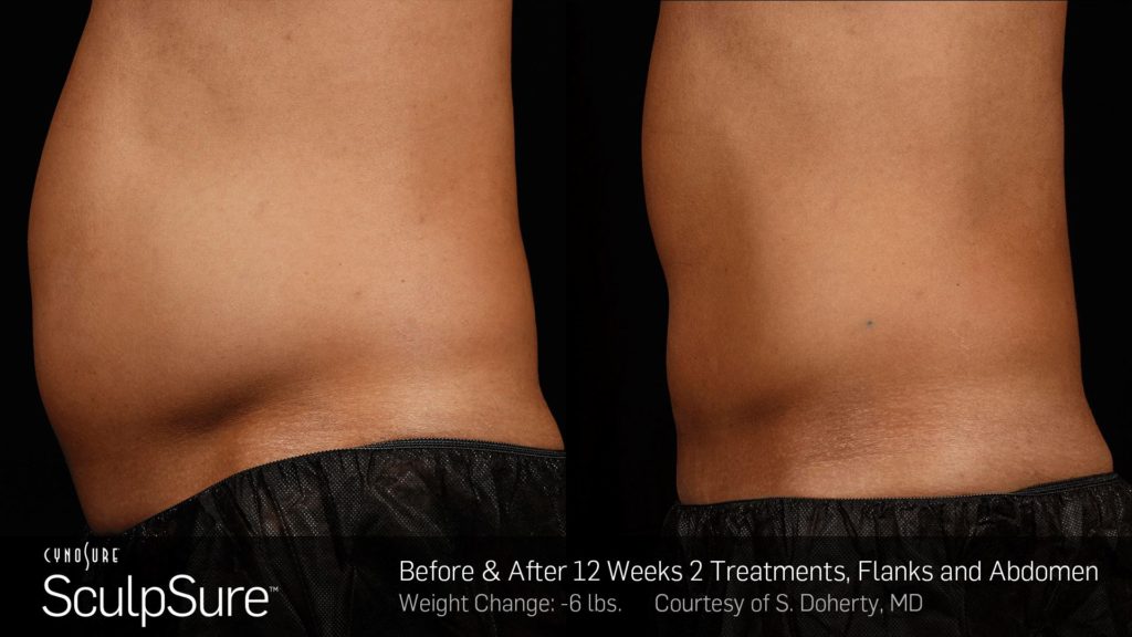 If Your Clothes Could Talk: SculpSure Another Way To Get Rid Of Unwanted Fat