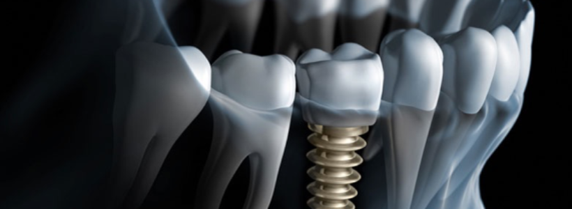 Crowns and Dental Implants Restore Young Hockey Players' Smiles