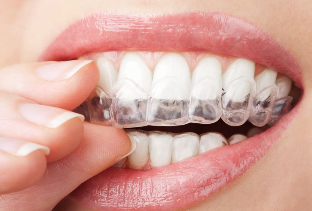 3 Easy Teeth Correction Options for an Improved Smile