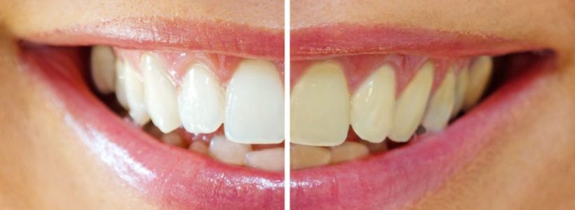 Types of Teeth Stains and How to Remove Them