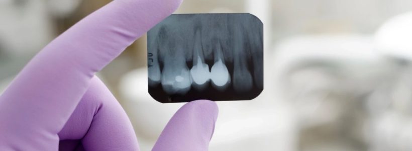 Filling the gaps: What are dental implants and when do you need them?